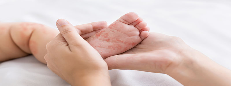 Hands holding baby's foot with skin rash
