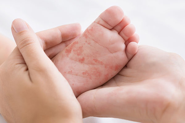 Hands holding baby's foot with rash